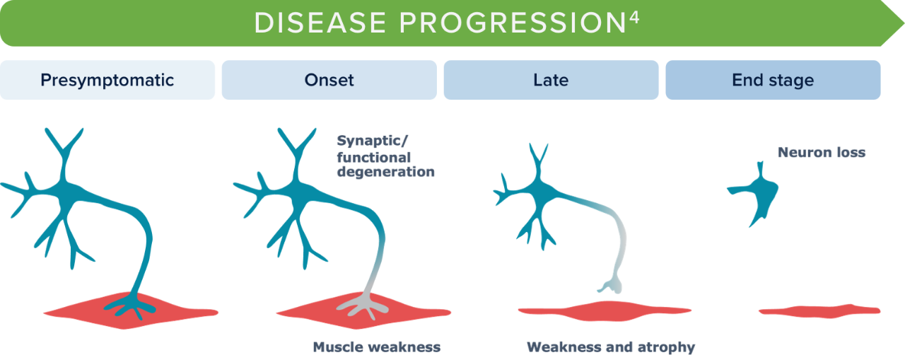 Motor neuron degeneration graphic