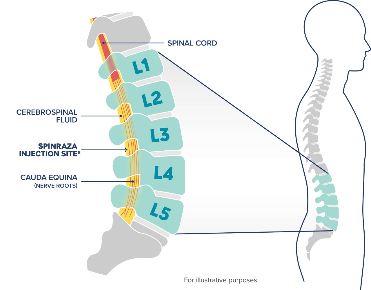 Icon of human showing the spine with an expanded section showing the details of the lumbar spine, including the SPINRAZA injection site into the cerebrospinal fluid between L3 and L4, below the spinal cord