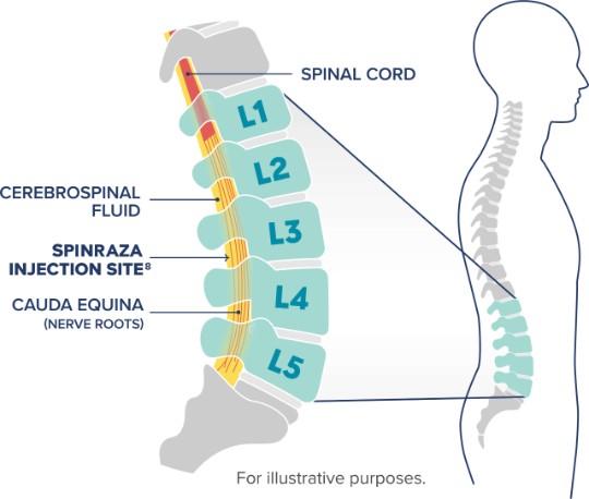 Icon of human showing the spine with an expanded section showing the details of the lumbar spine, including the SPINRAZA injection site into the cerebrospinal fluid between L3 and L4, below the spinal cord
